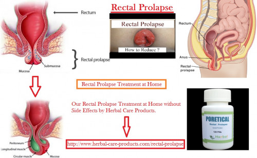 10-Natural-Remedies-for-Rectal-Prolapse.jpg