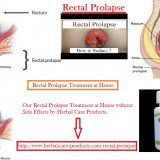 10-Natural-Remedies-for-Rectal-Prolapse