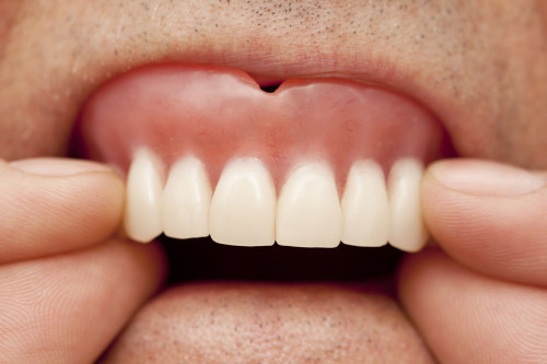 Caring-for-Your-Mouth-and-Gums-with-Dentures.jpg