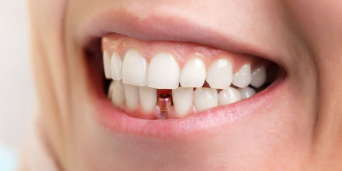 Dental-Implant.jpg