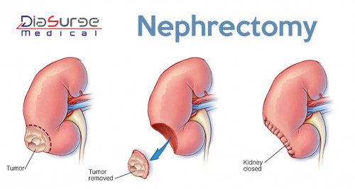 A Nephrectomy is the surgical removal of a kidney due to some medical problems. Renal cancer, cyst or any other condition in which donation of the kidney is needed. 
To perform this surgery surgeons uses the rigid laparoscope
For more visit: http://www.diasurge.com/