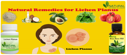 For making one of the helpful Natural Remedies for Lichen Planus you should add four ounces of Aloe Vera gel and one tablespoon of coconut oil. You should mix it well... https://www.naturalherbsclinic.com/blog/herbal-supplements-and-natural-remedies-for-lichen-planus/