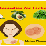 Herbal-Supplements-and-Natural-Remedies-for-Lichen-Planus