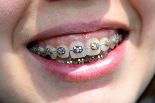 How-Braces-Can-Affect-Your-Face-and-Jaw.jpg