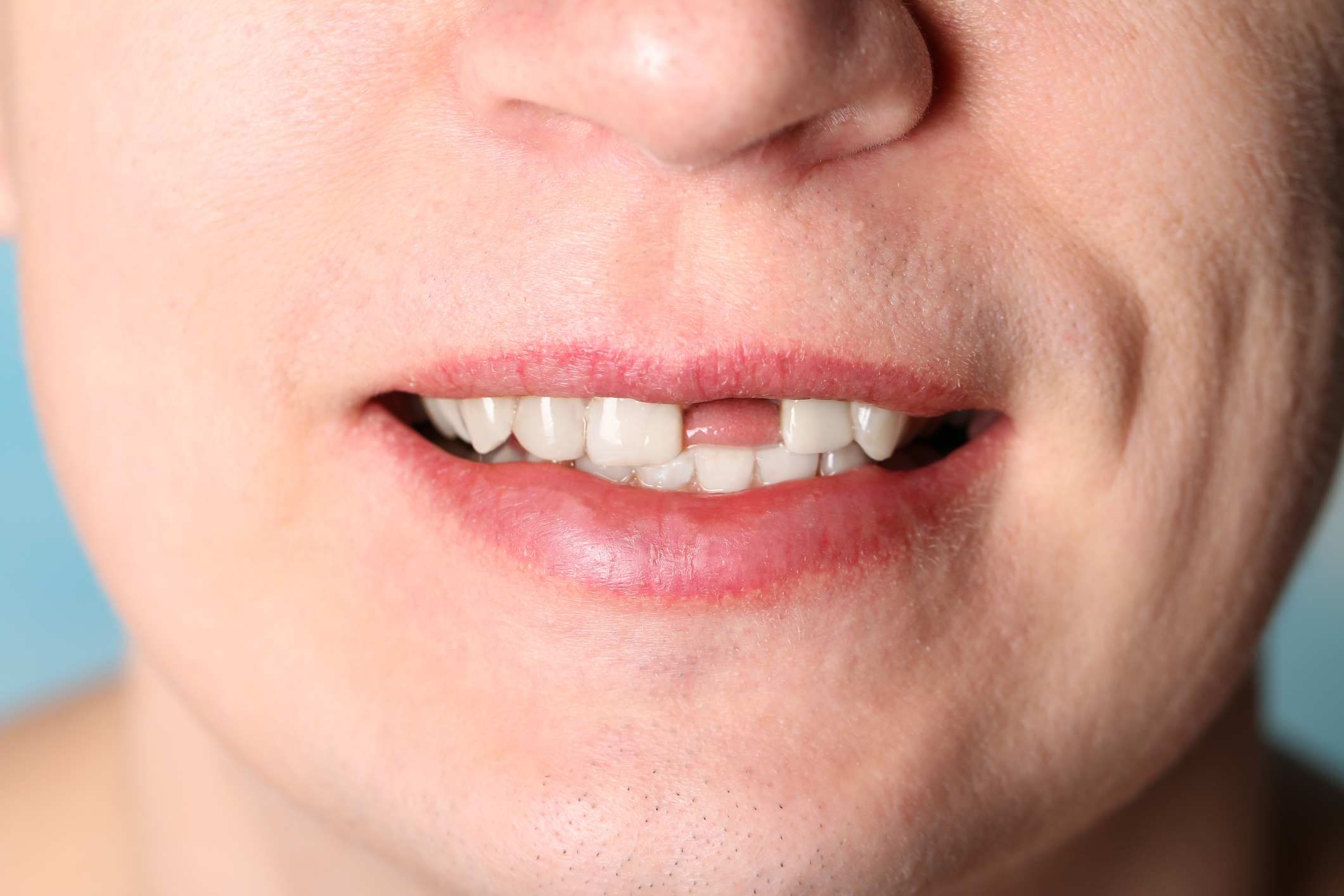 Сон рот без зубов. Частичное отсутствие зубов. Отсутствие передних зубов. Отсутствуют передние зубы.
