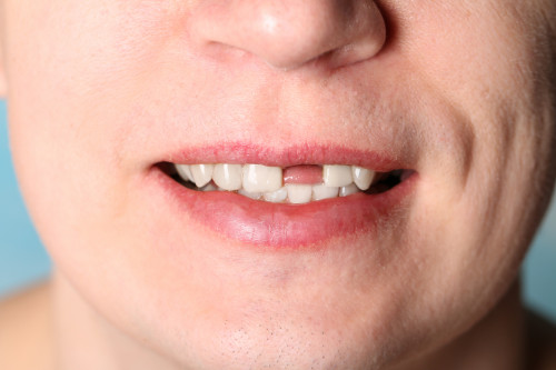 How-Long-Should-I-Wait-for-a-Tooth-Implant.jpg