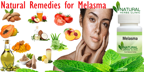 Lemon Juice is one of the most effective Natural Remedies for Melasma. You can make use of lemon juice to treat other skin-related diseases such as acne scars, blemishes, blackheads, and dark underarms... https://www.onfeetnation.com/profiles/blogs/natural-remedies-for-melasma-the-ultimate-guide-to