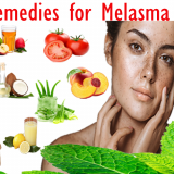 Melasma