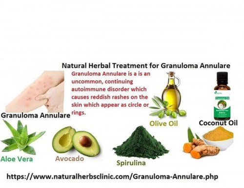 Natural-Herbal-Treatment-of-Granuloma-Annulare-Skin-Disorder-Infection.jpg