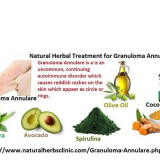 Natural-Herbal-Treatment-of-Granuloma-Annulare-Skin-Disorder-Infection