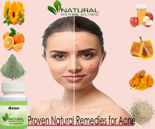 Natural-Remedies-for-Acne.png