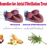 Natural-Remedies-for-Atrial-Fibrillation