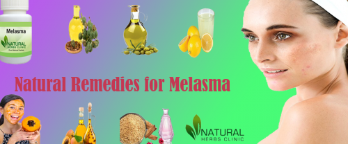 Lemon juice is the best Natural Remedies for Melasma cure. Its acidic nature and vitamin C component improve the discolorations and peel off the outer layer of the skin... https://alternativetreatment.medium.com/natural-remedies-for-melasma-bb08f36f201e