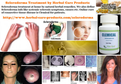 Herbal Treatment for Scleroderma can help with everything from digestion to immune system function. Herbal Remedies for Scleroderma you can do to help manage your condition.
https://www.herbal-care-products.com/product/scleroderma/