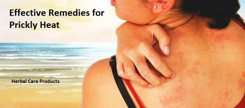 To learn what to put on prickly heat rash, visit Herbal Care Products You'll find dozens of articles about skin problems and skin care by clicking on common skin problems. If you are trouble by prickly heat and want to buy Herbal Supplements for Prickly Heat to soothe the skin and prevent more eruptions.
https://www.herbal-care-products.com/blog/effective-remedies-for-prickly-heat-that-work/