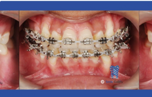 Smile gallery the best dental clinic in Bhopal provides root canal treatment at an affordable cost. Painless Root Canal Treatment in Bhopal is now possible."

Visit at: https://smile-gallery.com/