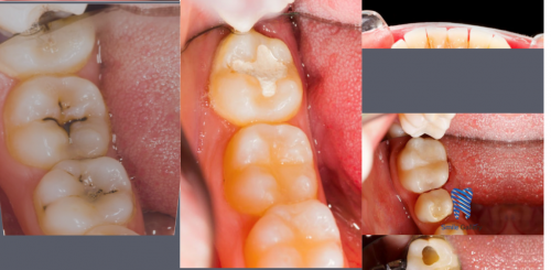 Root-canal-Treatment-cost-in-Bhopal.png