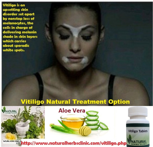 Aloe vera gel can be used both internally and externally. Aloe vera is one of the useful Herbal Remedies for vitiligo. Aloe vera has been known to soften and heal the skin and make the spots fade away. https://www.naturalherbsclinic.com/blog/natural-herbal-treatment-for-vitiligo-with-aloe-vera/