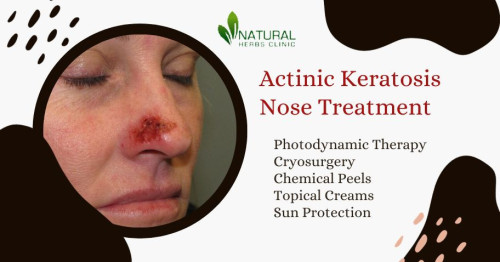 While actinic keratosis can ultimately lead to skin cancer, treatment options are available to prevent further damage and remove the lesions. Here we will provide an overview of the latest advances in Actinic Keratosis Nose Treatment. https://www.naturalherbsclinic.com/blog/actinic-keratosis-nose-treatment-an-overview-of-the-latest-strategies/