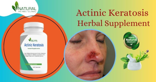 Introducing our revolutionary Herbal Supplement for Actinic Keratosis Natural Treatment – your path to radiant, healthy skin. Say goodbye to the discomfort and unsightly blemishes caused by actinic keratosis and embrace the natural solution that will rejuvenate your skin and boost your confidence. https://www.naturalherbsclinic.com/product/actinic-keratosis/