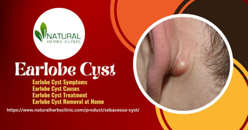 Living with an earlobe cyst can be uncomfortable and embarrassing. Fortunately, there are simple steps you can take Earlobe Cyst Removal at Home without the need for a doctor’s visit. From choosing the right products to understanding the removal process, here is how you can remove an earlobe cyst from your own home. https://www.naturalherbsclinic.com/blog/simple-steps-to-earlobe-cyst-removal-at-home-without-doctor-need/
