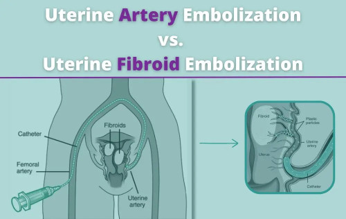 Looking for a non-surgical solution for uterine fibroids? Learn how Uterine Artery Embolization (UAE), a synonym for Uterine Fibroid Embolization is, can provide relief. Our latest blog explains the key differences and why UAE is a game-changer. Say goodbye to fibroid-related discomfort and hello to a better quality of life. Read more at USA Fibroid Centers now!
https://www.usafibroidcenters.com/blog/uterine-artery-embolization-vs-uterine-fibroid-embolization/