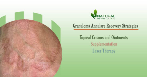 There are many Granuloma Annulare Recovery Strategies that can help reduce the appearance of the condition. https://www.naturalherbsclinic.com/blog/proven-granuloma-annulare-recovery-strategies-for-itchy-relief/