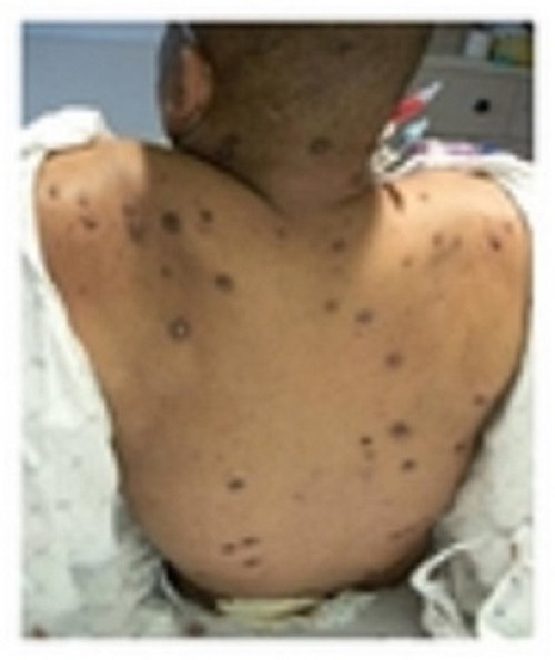 Waldenstroms Macroglobulinemia An uncommon skin disease
