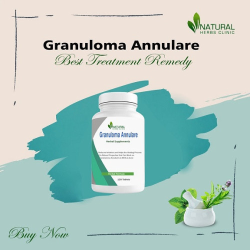 Looking for safe and effective ways for Natural Granuloma Annulare Care? Learn more about natural treatments and remedies that can help you manage the condition. https://theomnibuzz.com/natural-granuloma-annulare-care-safe-and-effective-ways-to-keep-the-lavish-skin/
