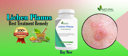 Get Knowledge about how ancient Ayurvedic Solutions for Lichen Planus can help you manage condition symptoms. Read about the potential health benefits and how to incorporate these practices into your daily life. https://www.party.biz/blogs/158777/347083/ayurvedic-solutions-for-lichen-planus-defining-the-benefits