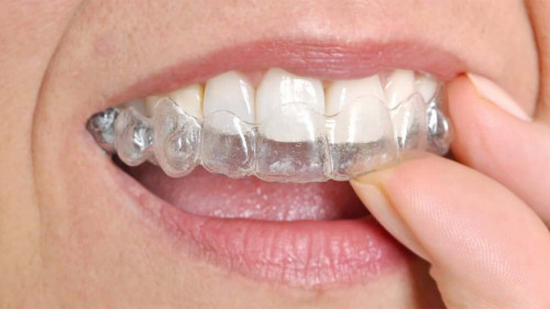 The-Most-Important-Facts-You-Need-To-Know-About-Invisalign.jpg