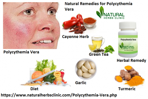 Polycythemia is a long-running situation and does not have any procedure of treatment or says it can’t be cured. Though, specialists are of the outlook that intake of Natural Remedies for Polycythemia Vera could assist in thinning of blood and obstruct blood clots... https://herbalresource.livejournal.com/9031.html