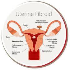 USA-Fibroids-Center.jpg