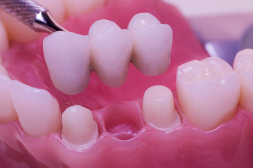 What-Is-a-Dental-Bridge.jpg