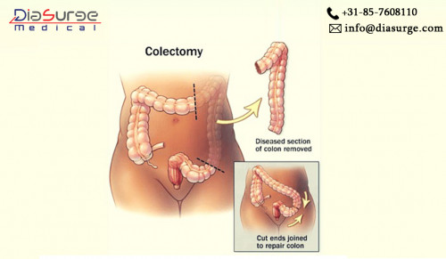 Colectomy is done in case of uncontrolled colon bleeding, obstruction, colon cancer, chron's disease, etc. With the help of Laparoscopic, medical monitor and other
equipment, the surgeon operate the surgery. 

For more info: ahk@diasurge.NL