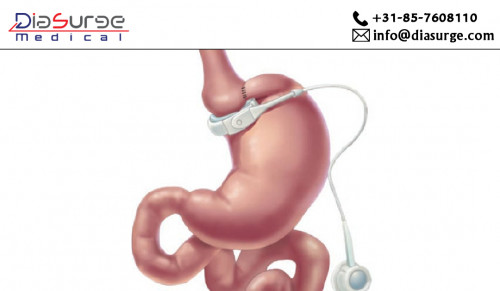 LABG is a laparoscopic procedure in which a band is placed to the stomach below the oesophagus and make a structure like a small pouch. This laparoscopic procedure is performed with the help of laparoscopic surgeon devices.